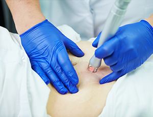 Stretch Mark Treatment in Pimpri-Chinchwad